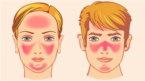 Связь между покраснением лица и болью в суставах